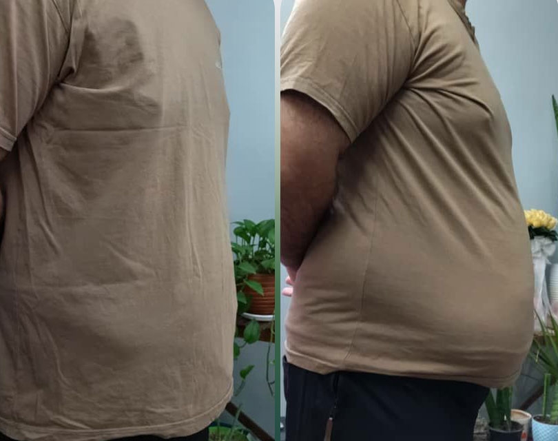 بای پس معده